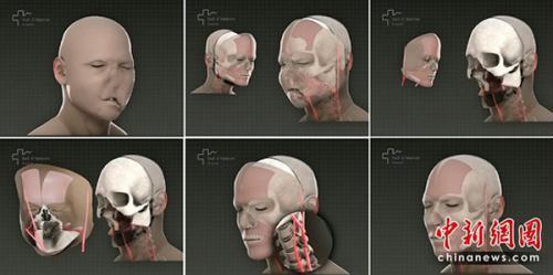 Vall&nbsp;d'Hebron&nbsp;Hospital&nbsp;in&nbsp;Barcelona,&nbsp;capital&nbsp;city&nbsp;of&nbsp;Spain,&nbsp;claimed&nbsp;to&nbsp;have&nbsp;accomplished&nbsp;world's&nbsp;first&nbsp;full-face&nbsp;transplant&nbsp;March&nbsp;20,&nbsp;2010.&nbsp;The&nbsp;surgery&nbsp;was&nbsp;done&nbsp;by&nbsp;a&nbsp;team&nbsp;of&nbsp;30&nbsp;doctors&nbsp;and&nbsp;lasted&nbsp;for&nbsp;24&nbsp;hours,&nbsp;according&nbsp;to&nbsp;the&nbsp;hospital.&nbsp;(Photo:&nbsp;chinanews.com)